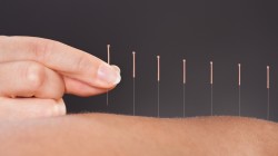 Este acupunctura remediul potrivit pentru tine?
