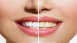 Unde este mai rentabil sa iti albesti dintii?