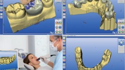 What is CAD/ CAM Dentistry?